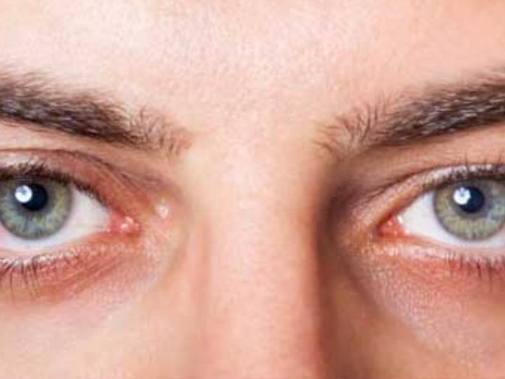 ड्राय आंख की समस्या से आपके देखने की शक्ति भी कम हो सकती है. और एक समय के बाद आपको काम करने में भी कई तरह की मुश्किलें आ सकती है.