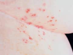 Scabies: रात के वक्त बाल और स्किन पर होने वाली खुजली को डैंड्रफ न समझें, नहीं तो इंफेक्शन से हो जाएगा पूरा मुंह खराब