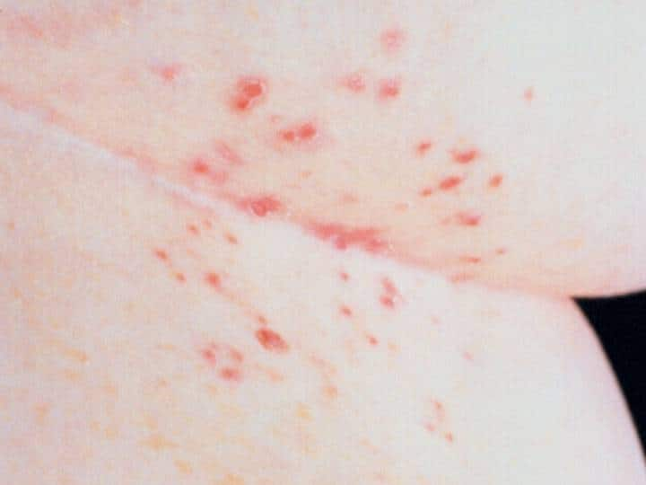 स्केबीज (Scabies) स्किन से जुड़ी एक गंभीर बीमारी है. जिसमें स्किन पर खुजली (Itchy skin rash) और दाने होने लगते हैं. यह बीमारी सरकोप्टेस स्केबी (Sarcoptes scabiei) नाम के एक छोटे से कीड़े से होता है.