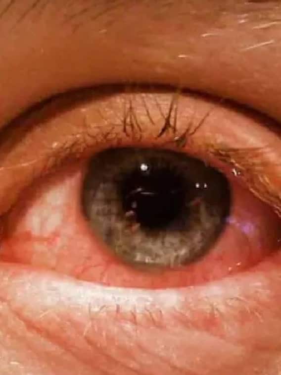 தமிழகத்தை அச்சுறுத்தும் மெட்ராஸ் ஐ