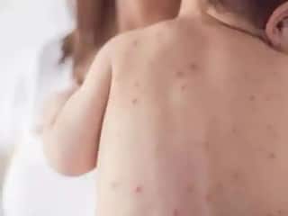 Health Tips : गोवर आणि कांजण्या यामध्ये नेमका फरक काय? संसर्ग झाल्यास कशी काळजी घ्याल? वाचा तज्ज्ञांचा सल्ला