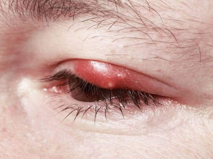 आंखें हमारे शरीर का अहम हिस्सा होने के बावजूद यही वह माध्यम है जिसके जरिए हम यह खूबसूरत दुनिया देखते हैं. आंखों में अगर कोई भी छोटी से छोटी या बड़ी समस्या हो जाए तो चेहरे की पूरी खूबसूरती खराब हो जाती है. ऐसी ही एक समस्या है आंख में गुहेरी