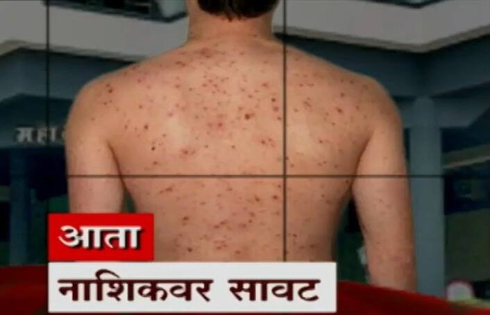 maharashtra news nashik News four suspected measles patients in Nashik city followed by Mumbai Malegaon Nashik News :  मुंबई, मालेगाव पाठोपाठ नाशिक शहरात गोवरचे 4 संशयित रुग्ण, महापालिका रुग्णालयात संसर्गजन्य कक्ष 