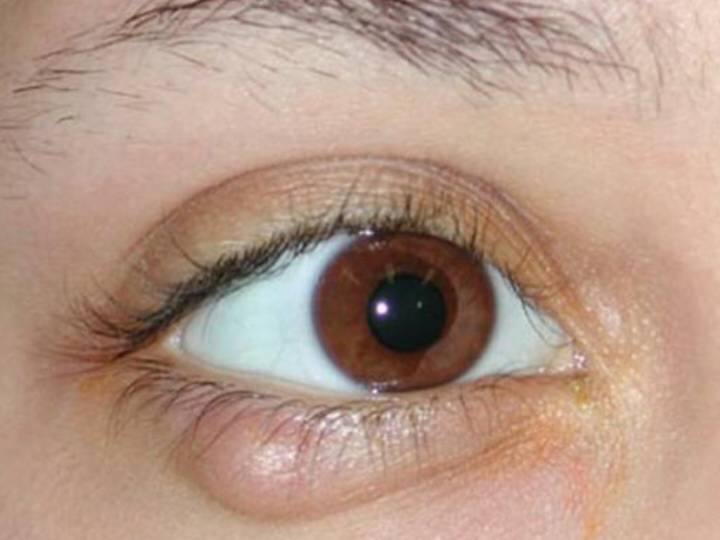 गुहेरी एक स्टैफिलोकोस ऑरिस बैक्टीरिया के कारण होता है. यह बैक्टीरिया आमतौर पर स्किन पर पाया दाता है. लेकिन यह बैक्टीरिया संक्रमण भी पैदा कर सकती है. बोलचाल की भाषा में कहे तो गुहेरी स्किन पर पाए जाने वाले बैक्टीरिया की वजह से होती है.