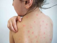 Measles Outbreak: காட்டு தீயாக பரவும் தட்டம்மை...8 மாத குழந்தை உயிரிழப்பு...உயரும் பலி எண்ணிக்கை..!