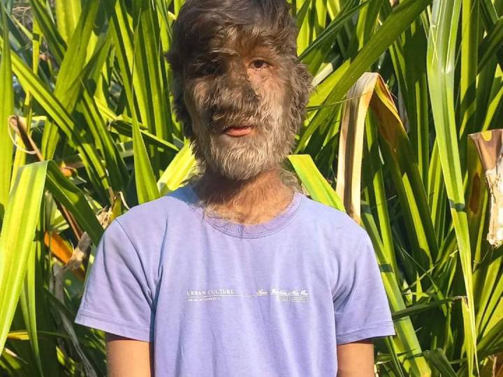 Werewolf Syndrome: एमपी का वह लड़का, जिसके चेहरे पर उगते हैं लंबे-लंबे बाल, हनुमान मानकर पूजा करते हैं लोग