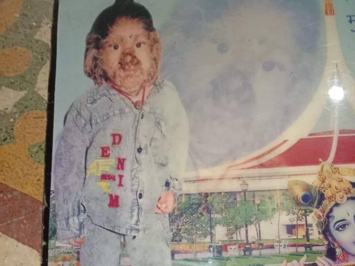 Werewolf Syndrome: एमपी का वह लड़का, जिसके चेहरे पर उगते हैं लंबे-लंबे बाल, हनुमान मानकर पूजा करते हैं लोग