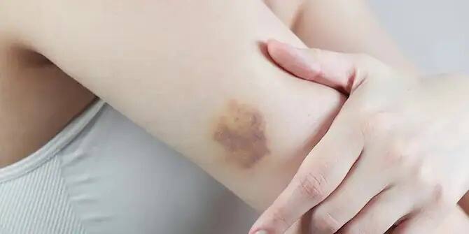 ਪਰ ਸੱਟ ਲੱਗਣ ਜਾਂ ਕਿਸੇ ਹੋਰ ਕਾਰਨ ਕਰਕੇ ਬਾਹਰ ਵਹਿਣ ਦੀ ਬਜਾਏ ਜੇਕਰ ਖੂਨ ਸਰੀਰ ਦੇ ਅੰਦਰ ਹੀ ਰਹਿ ਜਾਵੇ ਜਾਂ ਖੂਨ ਦਾ ਰਿਸਾਅ ਹੋ ਜਾਵੇ ਤਾਂ ਇਸ ਨੂੰ ਅੰਦਰੂਨੀ ਖੂਨ (ਇਨਟਰਨਲ ਬਲੀਡਿੰਗ) ਕਿਹਾ ਜਾਂਦਾ ਹੈ।