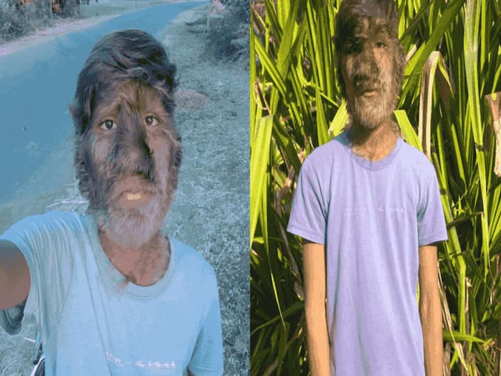 Madhya Pradesh Teen Suffering From Rare Werewolf Syndrome Has Dense Hair All Over His Body Madhya Pradesh Teen Suffering From Rare 'Werewolf Syndrome' Has Dense Hair All Over His Body