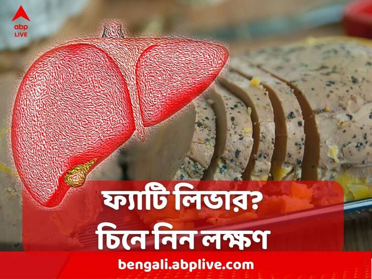 Fatty Liver 40% in India suffer from non-alcoholic fatty liver, Know the symptoms Fatty Liver : ভারতে প্রায় ৪০ শতাংশ আক্রান্ত ফ্যাটি লিভারে, কীভাবে চিনবেন রোগ