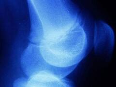 शरीर में दिखे ऐसे गांठ तो हो जाएं चौकन्ना, सारकोमा कैंसर की हो सकती है निशानी