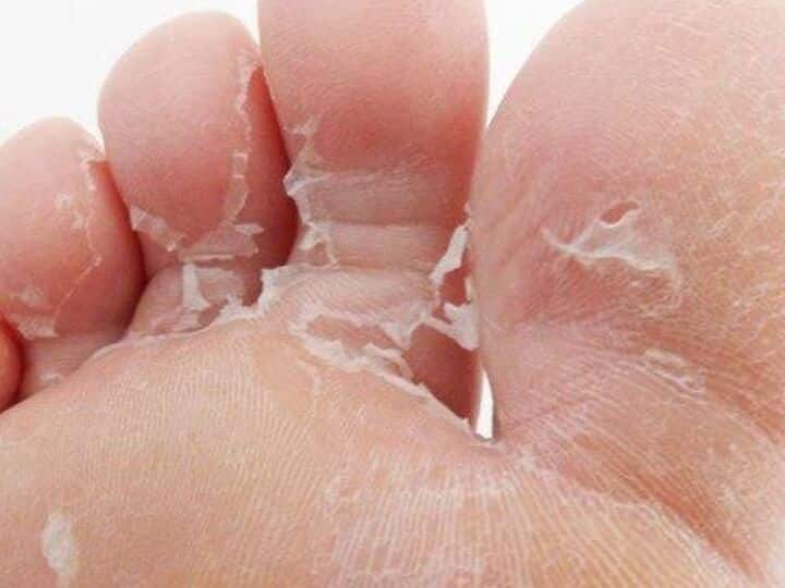 This mistake of yours causes the problem of skin peeling this is how to avoid it Skin Peeling: आपके रोजाना के इस गलती से होती है स्किन पीलिंग की समस्या, ऐसे करें बचाव