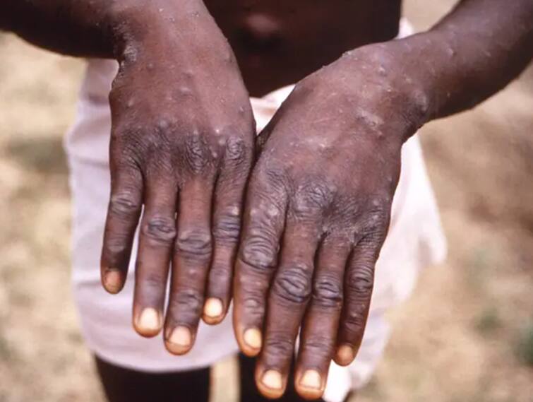 world health organization changed monkeypox s name to mpox Monkeypox : ਹੁਣ Monkeypox ਨੂੰ ਇਸ ਨਾਂ ਨਾਲ ਜਾਣਿਆ ਜਾਵੇਗਾ, WHO ਨੇ ਕੀਤਾ ਐਲਾਨ