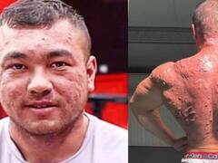 बॉडी बनाने के लिए लिया स्टेरॉयड, फिर शरीर में जो रिएक्शन हुए उसकी कहानी सुनकर हर कोई डर जाएगा