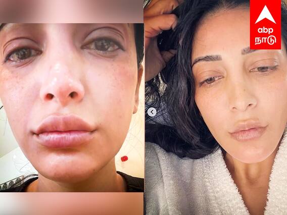 Shruti Haasan health condition : வீங்கிய உதடுகள்.. சிவந்த முகம்..ஸ்ருதிஹாசனா இது? அதிர்ச்சியில் ரசிகர்கள்!