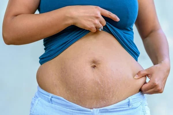 Belly Fat After Pregnancy: Why belly fat after delivery, know how to reduce it Belly Fat After Pregnancy : ਡਲਿਵਰੀ ਤੋਂ ਬਾਅਦ ਕਿਉਂ ਨਿਕਲ ਜਾਂਦੈ ਪੇਟ, ਜਾਣੋ ਇਸ ਨੂੰ ਘੱਟ ਕਰਨ ਦਾ ਤਰੀਕਾ