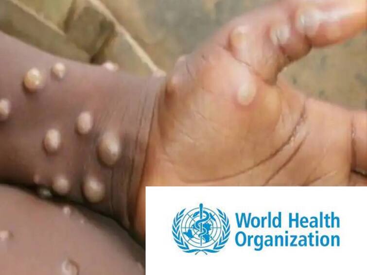 WHO recommends new name for monkeypox What to know about monkeypox Monkeypox virus: குரங்கு அம்மைக்கு புது பெயர் - உலக சுகாதார அமைப்பு அறிவிப்பு