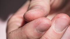 Skin Peeling : ਸਕਿਨ ਪੀਲਿੰਗ ਦੀ ਸਮੱਸਿਆ ਤੋਂ ਹੋ ਪਰੇਸ਼ਾਨ ਤਾਂ ਅਪਣਾਓ ਇਹ ਉਪਾਅ