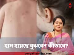 Measles outbreak: হঠাৎ বেড়েছে হামের প্রকোপ, কেন, কীভাবে বাঁচাবেন আপনার শিশুকে