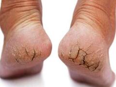 फटी एड़ियों पर मेडिकेटेड क्रीम नहीं बल्कि ये होममेड पेस्ट लगाएं, 2 दिनों में ठीक हो सकता है क्रैक हील