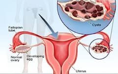 Ovary Cyst: શું હોય છે ઓવેરિયન સિસ્ટ, પોપ સિંગર જસ્ટિન બીબરની પત્ની આવી ચપેટમાં