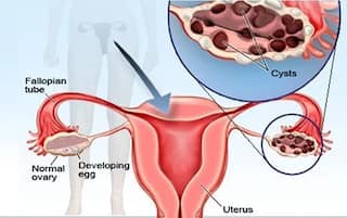 Ovary Cyst: શું હોય છે ઓવેરિયન સિસ્ટ, પોપ સિંગર જસ્ટિન બીબરની પત્ની આવી ચપેટમાં