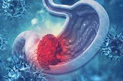 Stomch Cancer : ਐਸੀਡਿਟੀ ਤੇ ਪੇਟ ਫੁੱਲਣ ਦੀ ਸਮੱਸਿਆ 'ਚ ਨਾ ਵਰਤੋ ਲਾਪਰਵਾਹੀ, ਹੋ ਸਕਦੀ ਇਹ ਗੰਭੀਰ ਸਮੱਸਿਆ