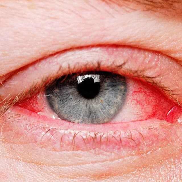 Red Eye: Causes, Symptoms, Treatment Red eyes cause: કેમ થઈ જાય છે લાલ આંખો? જાણો કારણ અને લક્ષણો