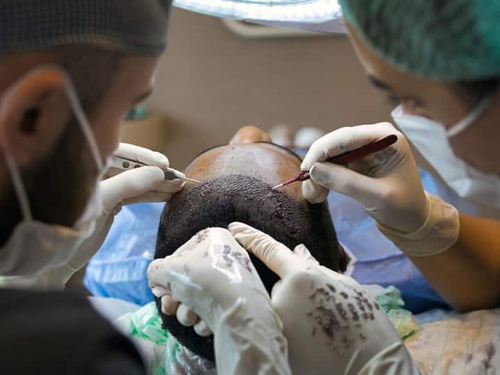 Hair transplant leads to painful death for 30-year-old: How hair transplant can turn fatal Hair transplant Side Effect: జుట్టు కోసం వెళ్లి ప్రాణాలు పోగొట్టుకున్న యువకుడు, సర్జరీ చేయించుకునే ముందు కాస్త జాగ్రత్త