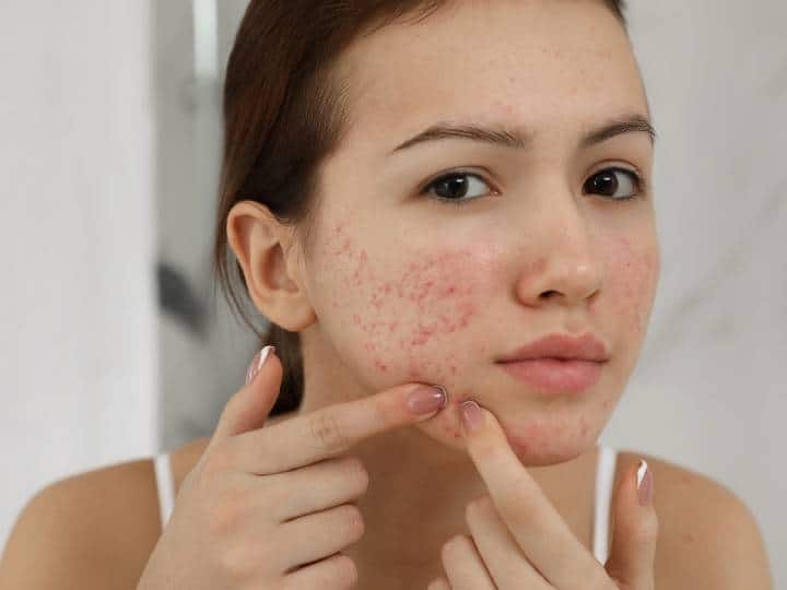 Pimples and pimples come out on the face by eating these things