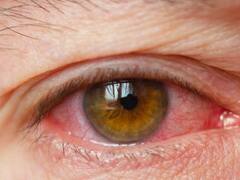 इस बीमारी की वजह हो जाते हैं अक्सर आंख लाल, वक्त रहते करवाएं इलाज