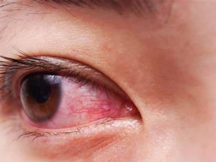 देर रात तक जागने से भी आंख लाल हो जाते हैं. कई बार शरीर में थकावट के कारण भी आंख लाल होने लग जाती हैं.