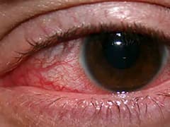 इस बीमारी की वजह हो जाते हैं अक्सर आंख लाल, वक्त रहते करवाएं इलाज