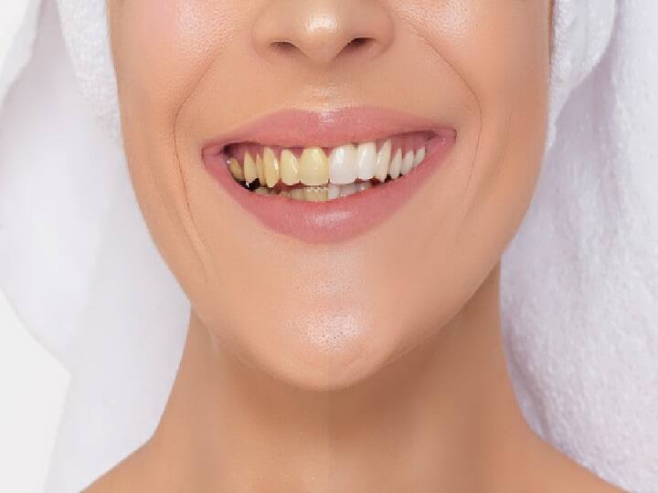 Teeth Whitening Tips: पीले दांतों की वजह से हंसने पर होते हैं शर्मिंदा, तो आज से ही घर में ये काम करना शुरू कर दें Teeth Whitening Tips You are embarrassed to smile because of yellow teeth so start doing this work at home from today itself Teeth Whitening Tips: पीले दांतों की वजह से हंसने पर होते हैं शर्मिंदा, तो आज से ही घर में ये काम करना शुरू कर दें