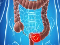 Health Tips: बार-बार भागना पड़ता है वॉशरूम, तो हो सकता है आंत का कैंसर दे रहा है सिग्नल, ऐसे पहचानें