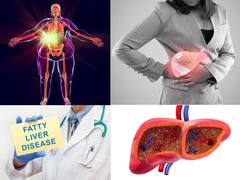 Liver cirrhosis: கல்லீரலில் பாதிப்பை உருவாக்கும் சில பழக்கவழக்கங்கள்!