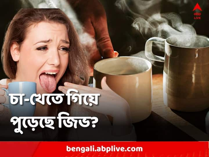 Reduce Burn Tips:চা খেতে গিয়ে জিভ পুড়ে গেলে তৎক্ষণাৎ যা করণীয়