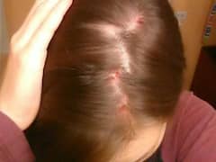 स्कैल्प एक्ने से उड़ गई है चेहरे की रंगत या झड़ रहे हैं बाल, जानें कारण और उपाय