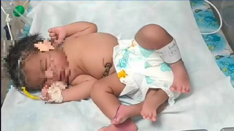 Gwalior News: Woman gave birth to a girl with 4 legs, doctors told the reason for this wonder Gwalior News: મહિલાએ 4 પગવાળી છોકરીને આપ્યો જન્મ, ડોક્ટરોએ જણાવ્યું આ અજાયબીનું કારણ