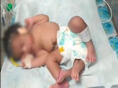Baby With Four Legs: மத்தியப் பிரதேசத்தில் நான்கு கால்களுடன் பிறந்த அதிசய குழந்தை..! இதுதான் காரணம்...