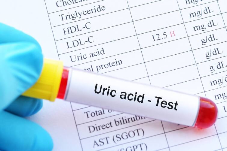 If you are troubled by increasing uric acid, then follow these home remedies, there will be no health problems