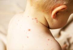 मुंबई में नहीं थम रहा खसरा का प्रकोप, संक्रमण के कारण पांच महीने के मासूम की मौत