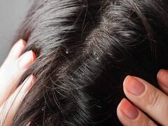 Hair: તમને પણ છે ડેન્ડ્રફની સમસ્યા, તો આ રહ્યા રામબાણ ઈલાજ, એક વાર જરૂર ટ્રાય કરો