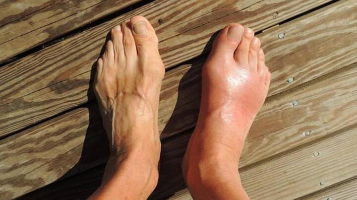 ਯੂਰਿਕ ਐਸਿਡ ਸਰੀਰ ਦਾ ਕੁਦਰਤੀ ਵੇਸਟ ਉਤਪਾਦ ਹੈ, ਜੋ ਸਰੀਰ ਤੋਂ ਬਾਹਰ ਨਿਕਲਦਾ ਰਹਿੰਦਾ ਹੈ, ਪਰ ਪਿਊਰੀਨ ਨਾਲ ਭਰਪੂਰ ਚੀਜ਼ਾਂ ਖਾਣ ਨਾਲ ਇਹ ਵਧ ਸਕਦਾ ਹੈ।