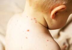 Measles in Mumbai : ਮੁੰਬਈ 'ਚ ਨਹੀਂ ਰੁਕ ਰਿਹਾ ਖਸਰੇ ਦਾ ਪ੍ਰਕੋਪ , ਇਨਫੈਕਸ਼ਨ ਕਾਰਨ ਪੰਜ ਮਹੀਨੇ ਦੇ ਬੱਚੇ ਦੀ ਮੌਤ