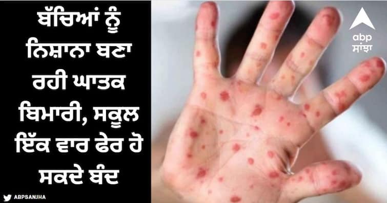 Tomato flu rage in the country, deadly disease targeting children Tomato flu: ਦੇਸ਼ 'ਚ ਟੋਮੈਟੋ ਫਲੂ ਦਾ ਕਹਿਰ, ਬੱਚਿਆਂ ਨੂੰ ਨਿਸ਼ਾਨਾ ਬਣਾ ਰਹੀ ਘਾਤਕ ਬਿਮਾਰੀ, ਸਕੂਲ ਇੱਕ ਵਾਰ ਫੇਰ ਹੋ ਸਕਦੇ ਬੰਦ : ਮਾਹਿਰ