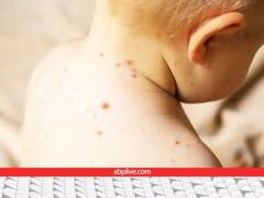 Measles से अब तक कितने बच्चों की मौत हुई, कितने हजार लोग बीमार पड़े, कौन सा राज्य सबसे ज्यादा प्रभावित रहा?