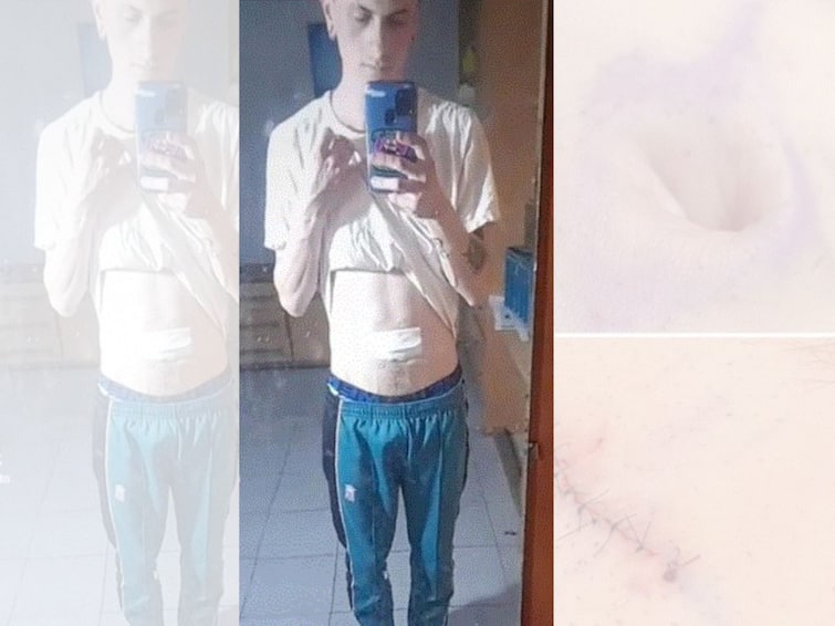 Social Media Creator Gets Belly Button Surgically Removed Says It Collected Dirt Social Media Creator Gets Belly Button Surgically Removed, Says It 'Collected Dirt'