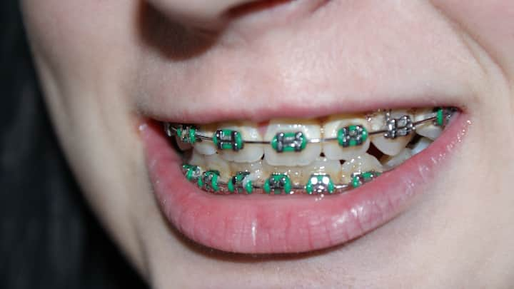 Braces Tips: 'ব্রেস' লাগানোর কথা ভাবছেন? বহু প্রয়োজনে অনেক সময়ই চিকিৎসকেরা আমাদের 'ব্রেস' লাগানোর পরামর্শ দেন।সেক্ষেত্রে অবশ্যই কয়েকটি বিষয় মাথায় রাখবেন, পরামর্শ বিশেষজ্ঞদের।