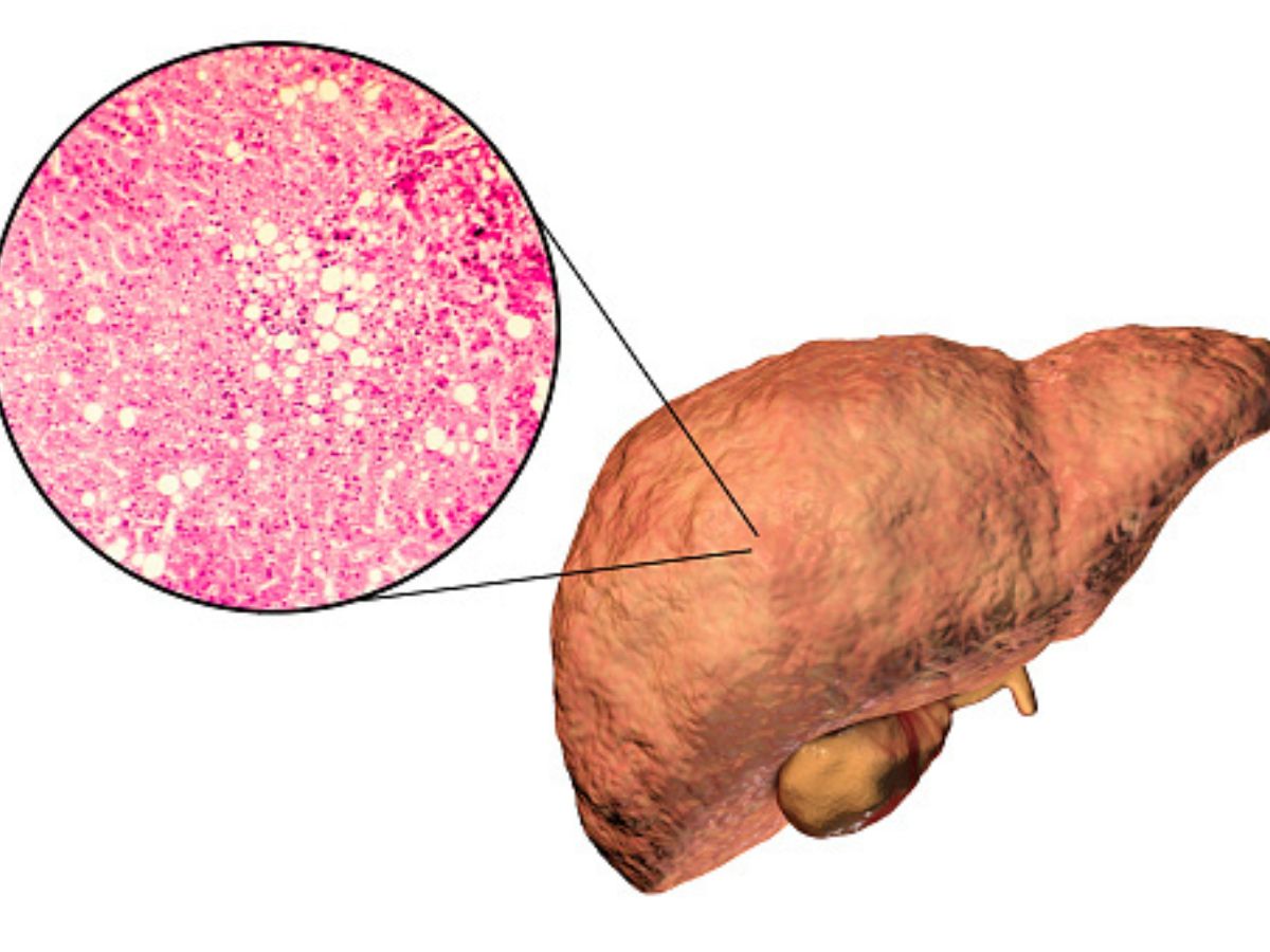 understanding-the-risks-is-grade-2-fatty-liver-dangerous